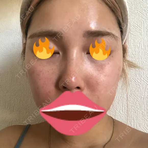 毛穴洗浄（ハイドラフェイシャルなど） / ピーリング（ハリ・ツヤ） / ミラノリピール Casa de GRACIA GINZA 【カーサデグラシアギンザ】 DAY 2 メイン用