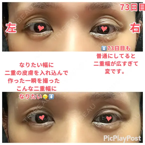 二重切開 / 眼瞼下垂（切開） / 上まぶたたるみ取り 心斎橋形成外科スキンケアクリニック DAY 73 メイン用