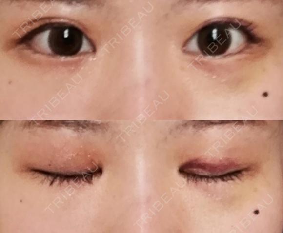 目頭切開 / 目尻切開 / 水光注射（ハリ・美肌） エートップ美容整形外科 DAY 12 メイン用