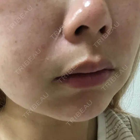 毛穴洗浄（ハイドラフェイシャルなど） / ピーリング（ハリ・ツヤ） / ミラノリピール Casa de GRACIA GINZA 【カーサデグラシアギンザ】 DAY 3 メイン用