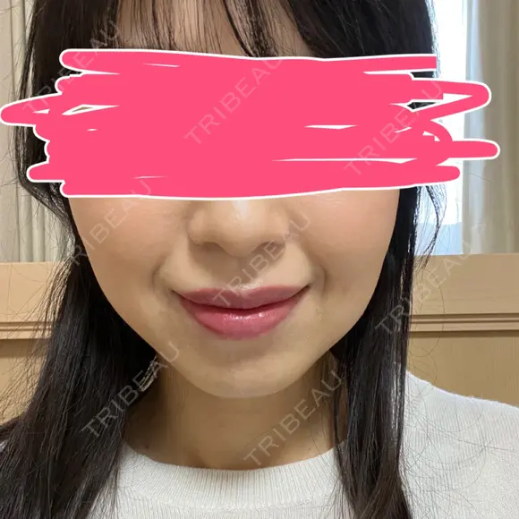 ボトックス（エラ・小顔） あいちビューティークリニック DAY 8 メイン用