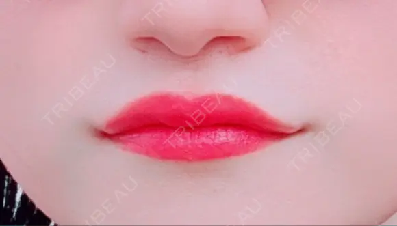ヒアルロン酸注入（唇） / ボトックス（口角） ブルームクリニック（BLOOM CLINIC） AFTER メイン用