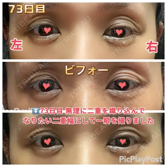 二重切開 / 眼瞼下垂（切開） / 上まぶたたるみ取り 心斎橋形成外科スキンケアクリニック DAY 73 メイン用