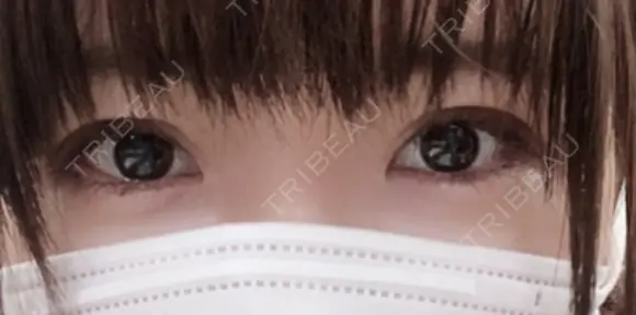 二重切開 / 目元修正 ルネッサンス美容外科医院 神戸院 DAY 47 メイン用