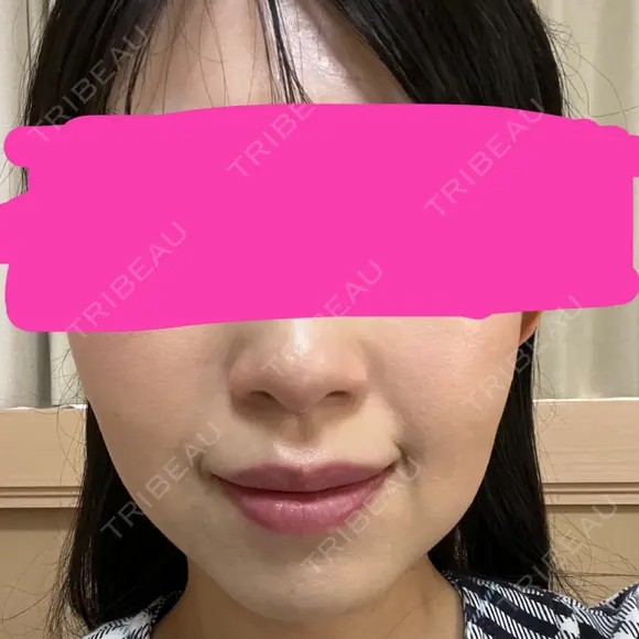 ボトックス（エラ・小顔） あいちビューティークリニック DAY 9 メイン用