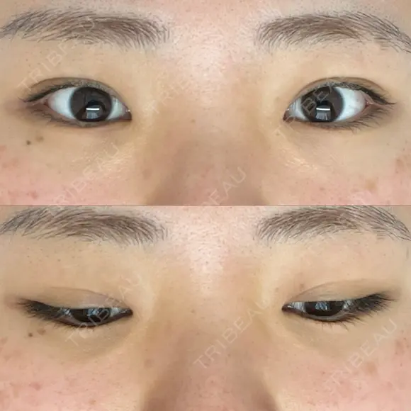 二重埋没 湘南美容クリニック 大阪心斎橋院 AFTER メイン用