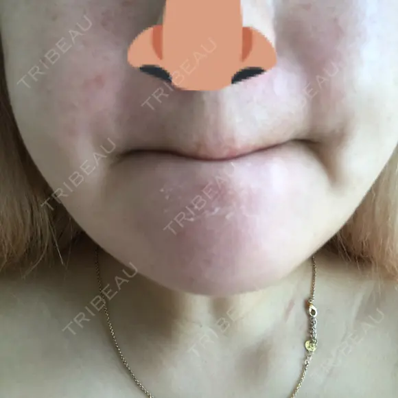 毛穴洗浄（ハイドラフェイシャルなど） / ピーリング（ハリ・ツヤ） / ミラノリピール Casa de GRACIA GINZA 【カーサデグラシアギンザ】 DAY 5 メイン用