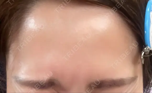 ボトックス（エラ・小顔） / ボトックス（眉間） / ボトックス（額） TCB東京中央美容外科 高崎院 AFTER メイン用