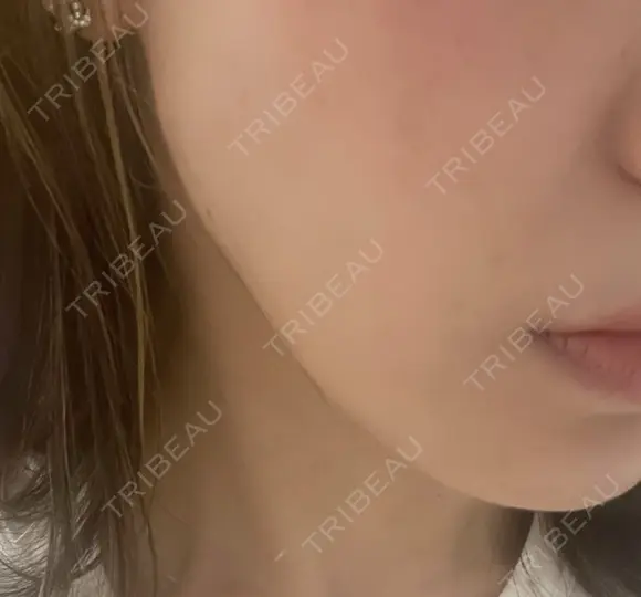 ボトックス（エラ・小顔） / ボトックス（眉間） / ボトックス（額） TCB東京中央美容外科 高崎院 DAY 0 メイン用