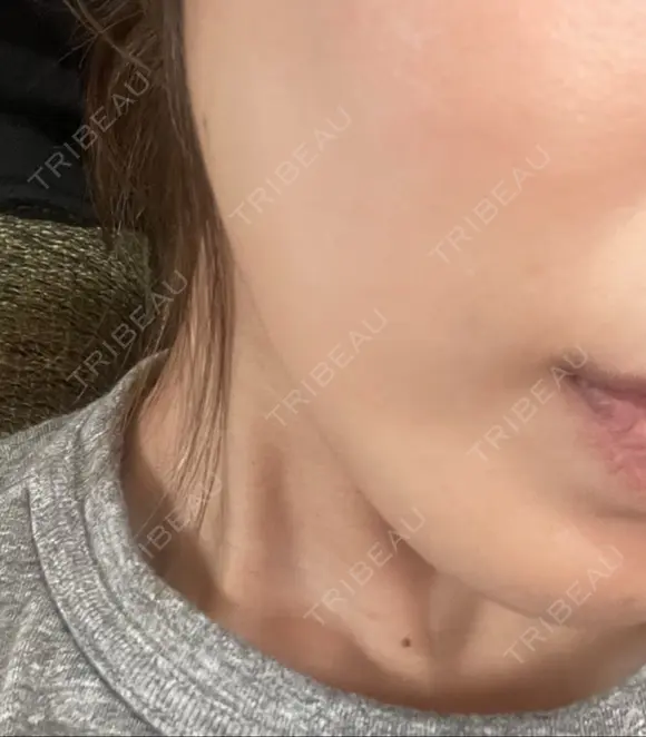 ボトックス（エラ・小顔） / ボトックス（眉間） / ボトックス（額） TCB東京中央美容外科 高崎院 DAY 6 メイン用