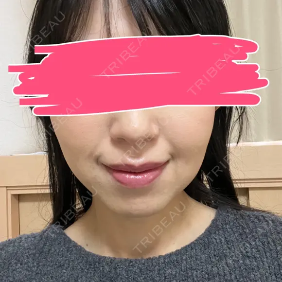 ボトックス（エラ・小顔） あいちビューティークリニック AFTER メイン用