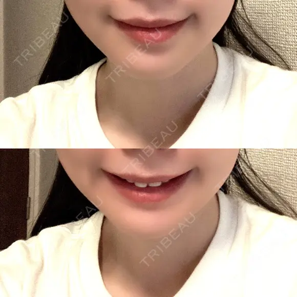 糸リフト / ルメッカ ブルームクリニック（BLOOM CLINIC） AFTER メイン用