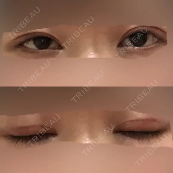 眼瞼下垂（切開） 十仁美容整形 DAY 24 メイン用