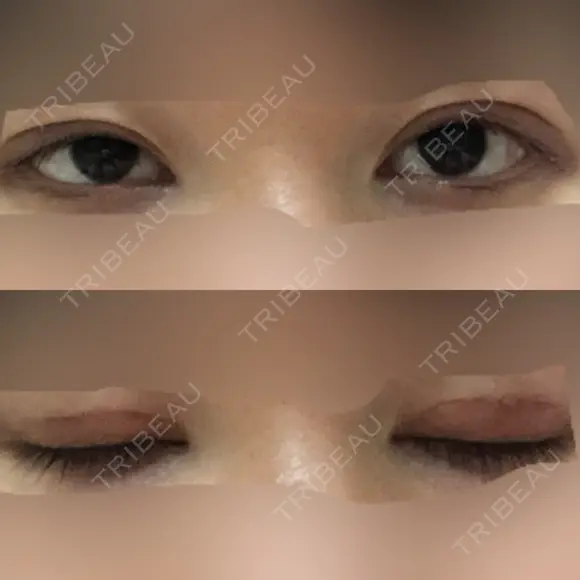 眼瞼下垂（切開） 十仁美容整形 DAY 26 メイン用