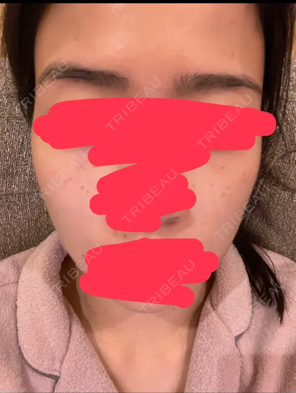 シミ取りレーザー CLINICA BellaForma DAY 3 メイン用