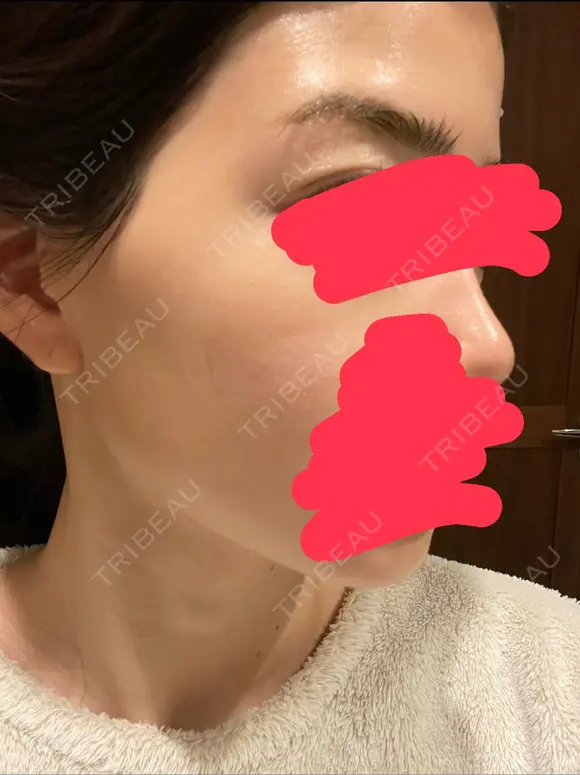 シミ取りレーザー CLINICA BellaForma AFTER メイン用