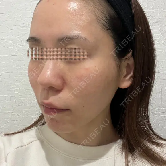 額を丸く / 脂肪注入（肌） / 脂肪注入（額） / 脂肪注入（輪郭） EMMA CLINIC（エマクリニック） DAY 90 メイン用