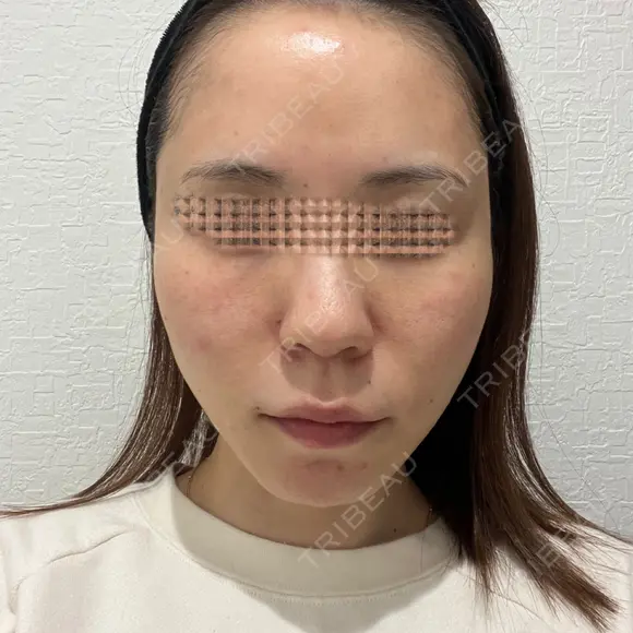 額を丸く / 脂肪注入（肌） / 脂肪注入（額） / 脂肪注入（輪郭） EMMA CLINIC（エマクリニック） AFTER メイン用
