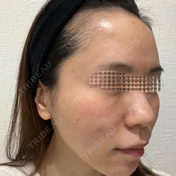 額を丸く / 脂肪注入（肌） / 脂肪注入（額） / 脂肪注入（輪郭） EMMA CLINIC（エマクリニック） DAY 90 メイン用