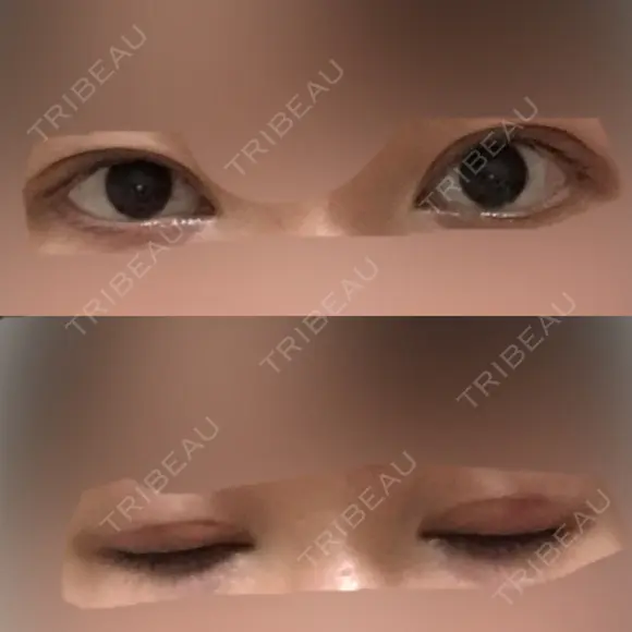 眼瞼下垂（切開） 十仁美容整形 DAY 28 メイン用