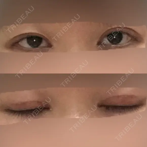 眼瞼下垂（切開） 十仁美容整形 DAY 29 メイン用