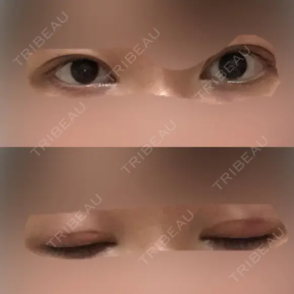 眼瞼下垂（切開） 十仁美容整形 DAY 27 メイン用