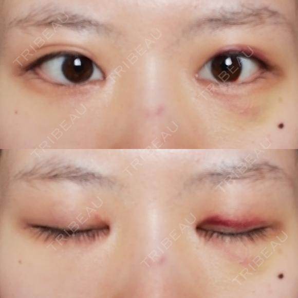 目頭切開 / 目尻切開 / 水光注射（ハリ・美肌） エートップ美容整形外科 DAY 13 メイン用
