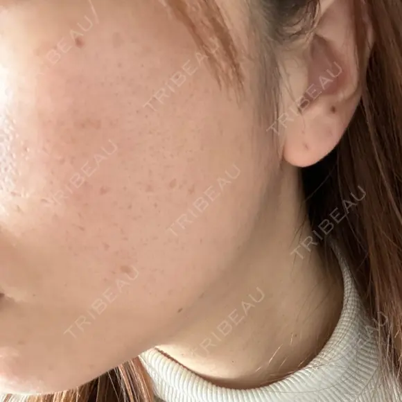 ピコフラクショナルレーザー（毛穴・ニキビ跡） CLINICA BellaForma AFTER メイン用