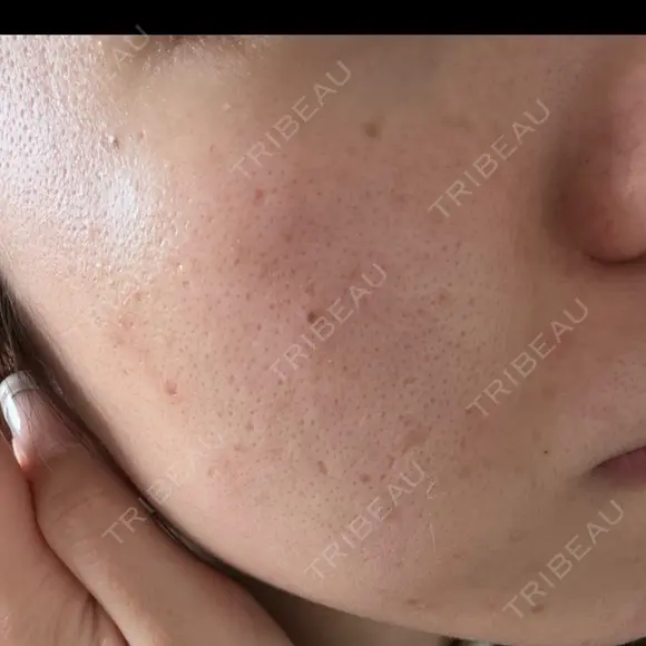 ピコフラクショナルレーザー（毛穴・ニキビ跡） CLINICA BellaForma DAY 35 メイン用