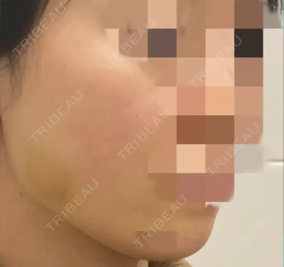 ボトックス（エラ・小顔） TCB東京中央美容外科 上野院 DAY 10 メイン用