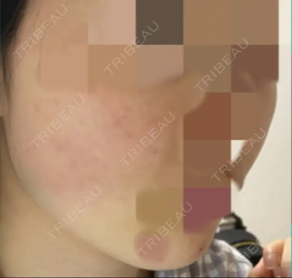 ボトックス（エラ・小顔） TCB東京中央美容外科 上野院 DAY 1 メイン用