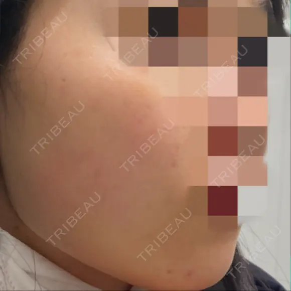 ボトックス（エラ・小顔） TCB東京中央美容外科 上野院 AFTER メイン用