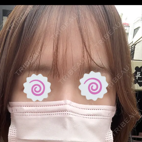 医療脱毛（顔） 渋谷美容外科クリニック 新宿院 AFTER メイン用