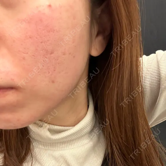 ピコフラクショナルレーザー（毛穴・ニキビ跡） CLINICA BellaForma DAY 0 メイン用