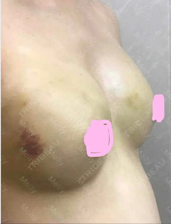 豊胸（脂肪注入） 湘南美容クリニック 那覇院 DAY 11 メイン用
