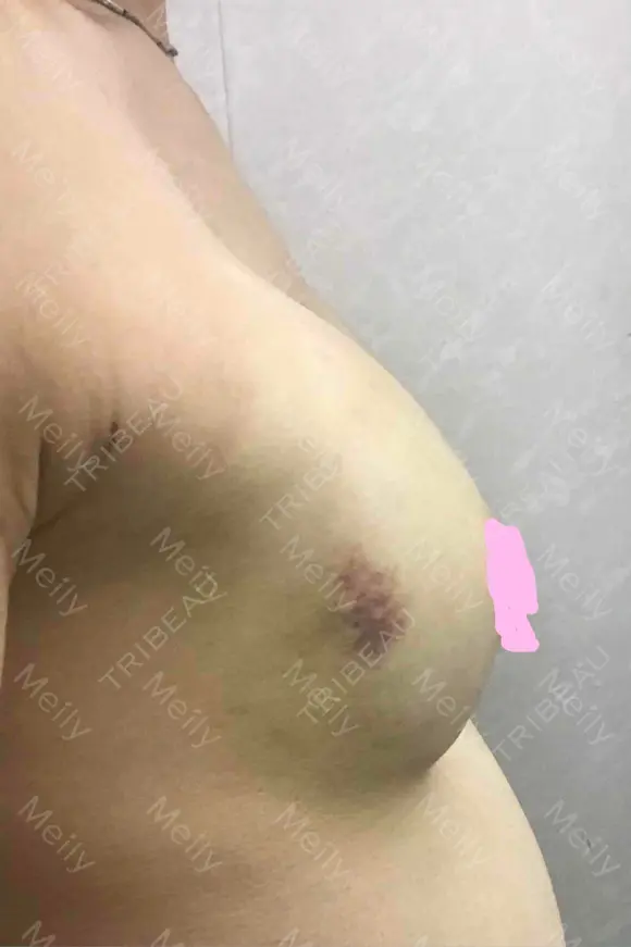 豊胸（脂肪注入） 湘南美容クリニック 那覇院 DAY 12 メイン用