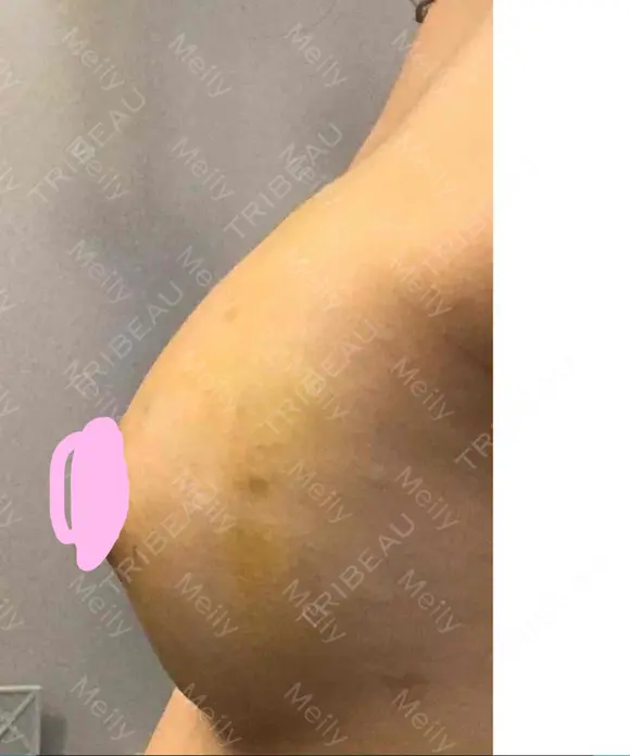 豊胸（脂肪注入） 湘南美容クリニック 那覇院 DAY 15 メイン用