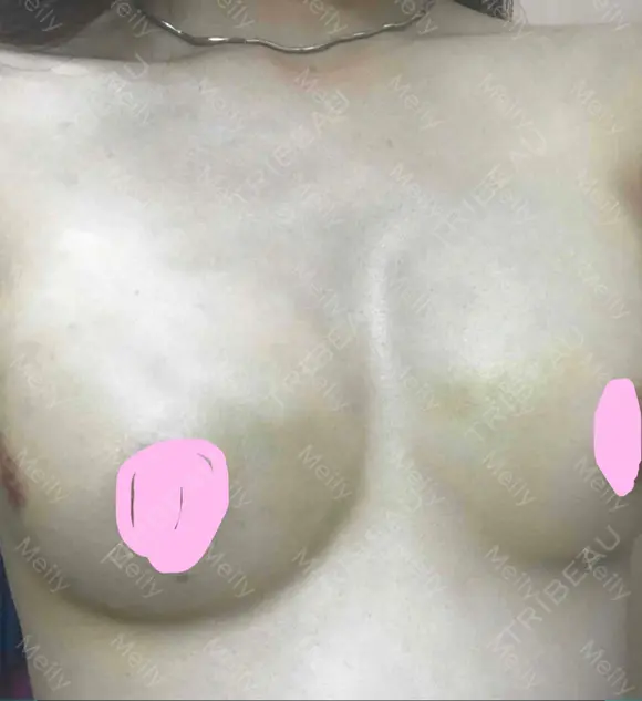 豊胸（脂肪注入） 湘南美容クリニック 那覇院 DAY 20 メイン用
