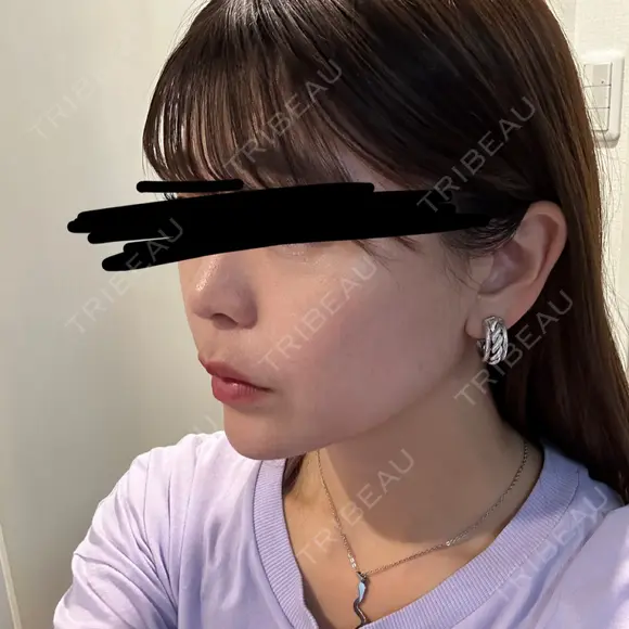 肌ヒアルロン酸注入（たるみ・シワ改善） / ヒアルロン酸注入（あご） / ボトックス（エラ・小顔） LE CLINIC DAY 1 メイン用