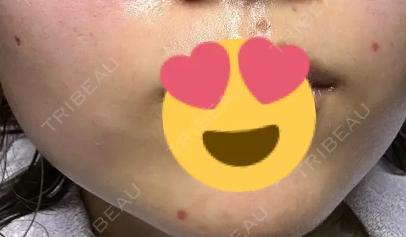 ほくろ・いぼ切除（肌） しらさぎ形成クリニック 徳島院 DAY 3 メイン用