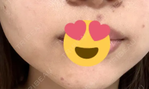 ほくろ・いぼ切除（肌） しらさぎ形成クリニック 徳島院 DAY 7 メイン用