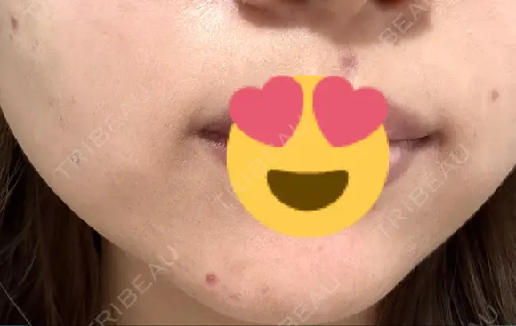 ほくろ・いぼ切除（肌） しらさぎ形成クリニック 徳島院 DAY 9 メイン用