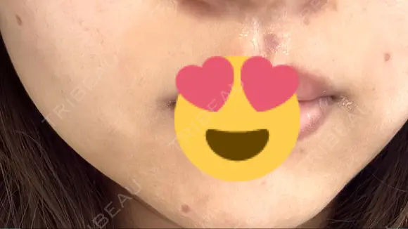 ほくろ・いぼ切除（肌） しらさぎ形成クリニック 徳島院 DAY 14 メイン用