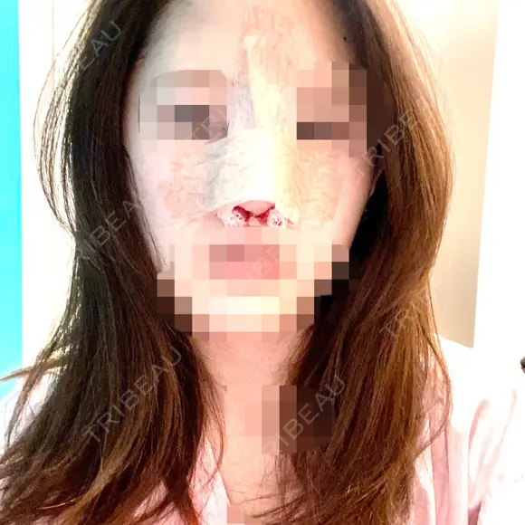 隆鼻術 / 鼻尖縮小 エースクリニック 名古屋院 DAY 0 メイン用