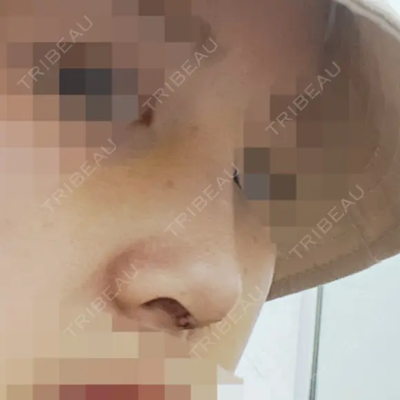 隆鼻術 / 鼻尖縮小 エースクリニック 名古屋院 AFTER メイン用