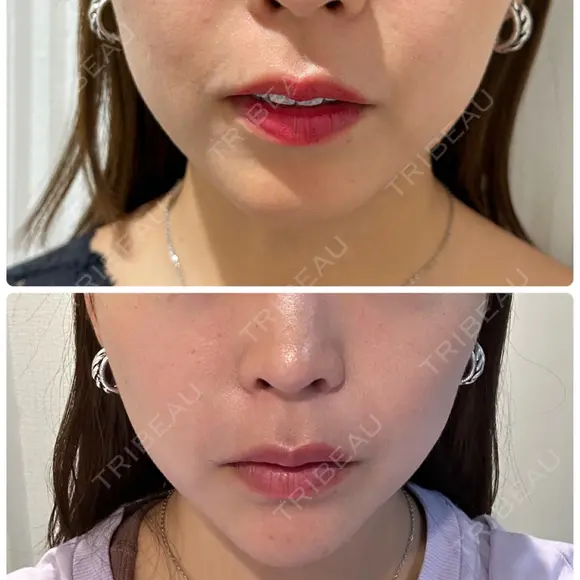 肌ヒアルロン酸注入（たるみ・シワ改善） / ヒアルロン酸注入（あご） / ボトックス（エラ・小顔） LE CLINIC AFTER メイン用