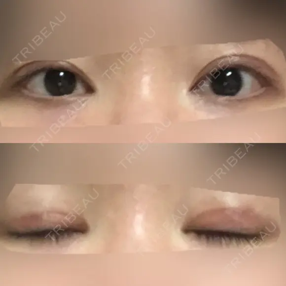 眼瞼下垂（切開） 十仁美容整形 DAY 35 メイン用