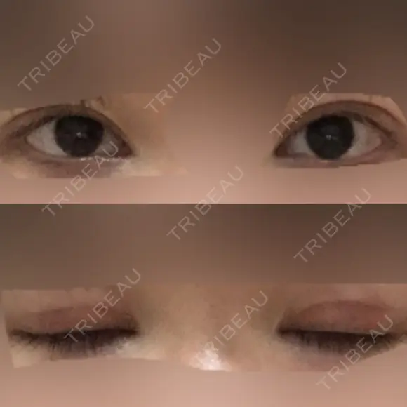 眼瞼下垂（切開） 十仁美容整形 AFTER メイン用
