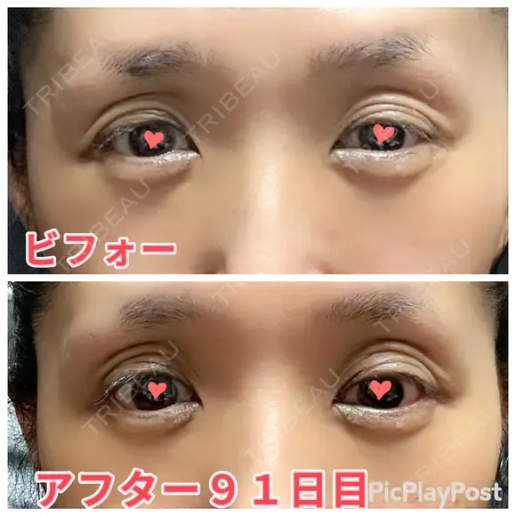 二重切開 / 眼瞼下垂（切開） / 上まぶたたるみ取り 心斎橋形成外科スキンケアクリニック DAY 91 メイン用