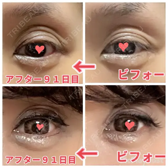 二重切開 / 眼瞼下垂（切開） / 上まぶたたるみ取り 心斎橋形成外科スキンケアクリニック DAY 91 メイン用